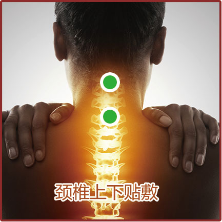 神經(jīng)根型、脊髓型頸椎病貼敷位置示意圖